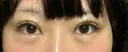 ヒアルロン酸注入（涙袋） 聖心美容クリニック 大阪院 DAY 1 サムネイル用