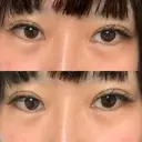 ヒアルロン酸注入（涙袋） 聖心美容クリニック 大阪院 DAY 1 サムネイル用