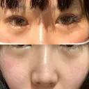 ヒアルロン酸注入（涙袋） 聖心美容クリニック 大阪院 AFTER サムネイル用