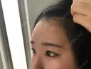ヒアルロン酸注入（額） 東京イセアクリニック DAY 2 サムネイル用
