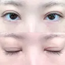 二重切開 松下皮フ形成外科 DAY 16 サムネイル用