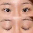 目頭切開 / 蒙古ひだ形成 / 目元修正 イブ整形外科 DAY 370 サムネイル用