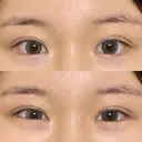 目頭切開 / 蒙古ひだ形成 / 目元修正 イブ整形外科 AFTER サムネイル用