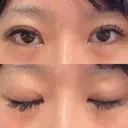 二重埋没 湘南美容クリニック Regno 銀座院 DAY 24 サムネイル用