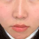 肌ヒアルロン酸注入（たるみ・シワ改善） 水の森美容クリニック 大阪梅田院 DAY 18 サムネイル用