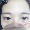 二重埋没 かわた美容クリニック AFTER サムネイル用