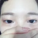 二重埋没 かわた美容クリニック DAY 250 サムネイル用