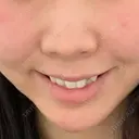 ガミースマイル手術 / 口角挙上 / ボトックス（口角） / その他（口元） 水の森美容クリニック 大阪梅田院 AFTER サムネイル用
