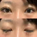二重埋没 湘南美容クリニック Regno 銀座院 DAY 25 サムネイル用