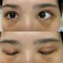 上まぶたの脂肪取り / 眉下切開 WOM CLINIC GINZA （ワム クリニック ギンザ） DAY 9 サムネイル用