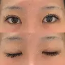 二重埋没 湘南美容クリニック Regno 銀座院 DAY 27 サムネイル用