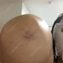 脂肪吸引（二の腕） ラインカルチャークリニック DAY 158 サムネイル用