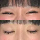 二重埋没 湘南美容クリニック Regno 銀座院 DAY 28 サムネイル用