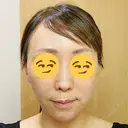 切開リフト 石倉クリニック 水戸院 DAY 74 サムネイル用