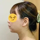 切開リフト 石倉クリニック 水戸院 DAY 74 サムネイル用