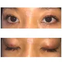 二重埋没 表参道スキンクリニック 表参道院 DAY 1 サムネイル用