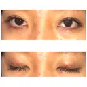 二重埋没 表参道スキンクリニック 表参道院 DAY 2 サムネイル用