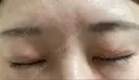 眼瞼下垂（切開） くさのたろうクリニック DAY 47 サムネイル用