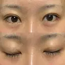 二重埋没 湘南美容クリニック Regno 銀座院 AFTER サムネイル用