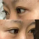 二重埋没 湘南美容クリニック Regno 銀座院 DAY 30 サムネイル用