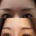 眉下切開 エイペックス美容外科 DAY 20 サムネイル用