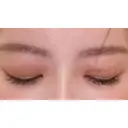 二重切開 / タレ目形成・グラマラスライン（切開） ハナキクリニック DAY 62 サムネイル用