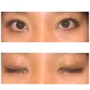 二重埋没 表参道スキンクリニック 表参道院 DAY 3 サムネイル用