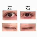 二重埋没 共立美容外科 大宮院 DAY 1 サムネイル用