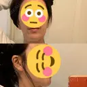 ボトックス（エラ・小顔） 湘南美容クリニック 藤沢院 AFTER サムネイル用