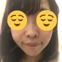 小鼻縮小（切開） / その他（鼻） 湘南メディカル記念病院（両国） DAY 51 サムネイル用