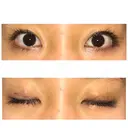 二重埋没 表参道スキンクリニック 表参道院 DAY 4 サムネイル用