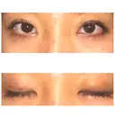 二重埋没 表参道スキンクリニック 表参道院 DAY 6 サムネイル用