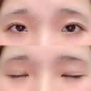 二重埋没 湘南美容クリニック 赤坂見附院 AFTER サムネイル用
