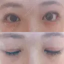 二重切開 / 眼瞼下垂（切開） / 目尻切開 ジュエリー美容外科 DAY 34 サムネイル用