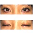 二重埋没 表参道スキンクリニック 表参道院 DAY 6 サムネイル用