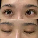 上まぶたの脂肪取り / 眉下切開 WOM CLINIC GINZA （ワム クリニック ギンザ） DAY 16 サムネイル用