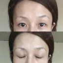 目尻切開 湘南美容クリニック 秋葉原院 DAY 41 サムネイル用