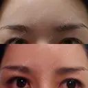 眉下切開 エイペックス美容外科 DAY 24 サムネイル用