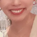 ガミースマイル手術 TCB東京中央美容外科 渋谷西口院 AFTER サムネイル用