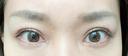 二重切開 / 目頭切開 心斎橋コムロ美容外科クリニック DAY 77 サムネイル用