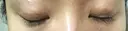 二重埋没 湘南美容クリニック 静岡院 DAY 12 サムネイル用