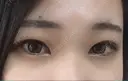 自然癒着法 マーブル美容整形外科 AFTER サムネイル用