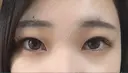 自然癒着法 マーブル美容整形外科 DAY 82 サムネイル用