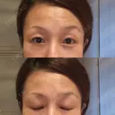 目尻切開 湘南美容クリニック 秋葉原院 DAY 44 サムネイル用