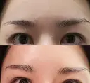 眉下切開 エイペックス美容外科 DAY 27 サムネイル用