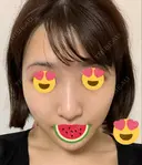 糸リフト / バッカルファット除去 / 脂肪吸引（顔） / ボトックス（エラ・小顔） WOM CLINIC GINZA （ワム クリニック ギンザ） DAY 20 サムネイル用