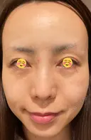クマ治療 / 再生医療 / PRP皮膚再生療法 銀座よしえクリニック 銀座院 DAY 37 サムネイル用