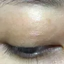 ほくろ・いぼ除去レーザー（肌） 仁愛クリニック DAY 25 サムネイル用