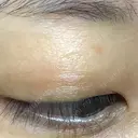ほくろ・いぼ除去レーザー（肌） 仁愛クリニック DAY 25 サムネイル用