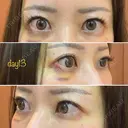 糸リフト / クマ治療 / 額を丸く / その他（輪郭） / こめかみ形成 / 脂肪注入（額） / 脂肪注入（輪郭） / その他（口元） 湘南美容クリニック 品川院 DAY 13 サムネイル用
